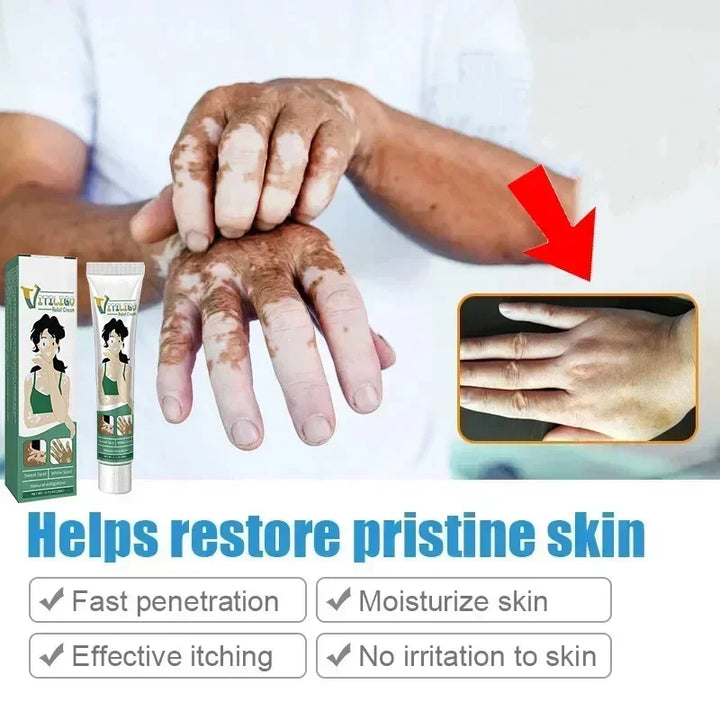 Herbal Extract Vitiligo Ointment Remove Ringworm White Spot Removal Skin care Vitiligo