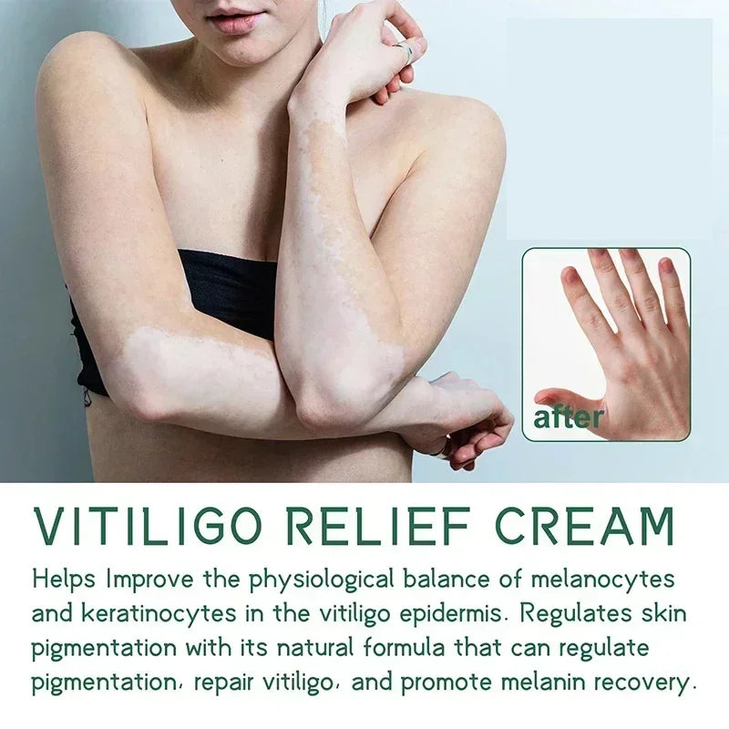 Herbal Extract Vitiligo Ointment Remove Ringworm White Spot Removal Skin care Vitiligo