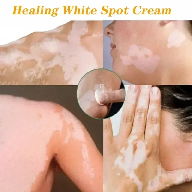 Herbal Extract Vitiligo Ointment Remove Ringworm White Spot Removal Skin care Vitiligo