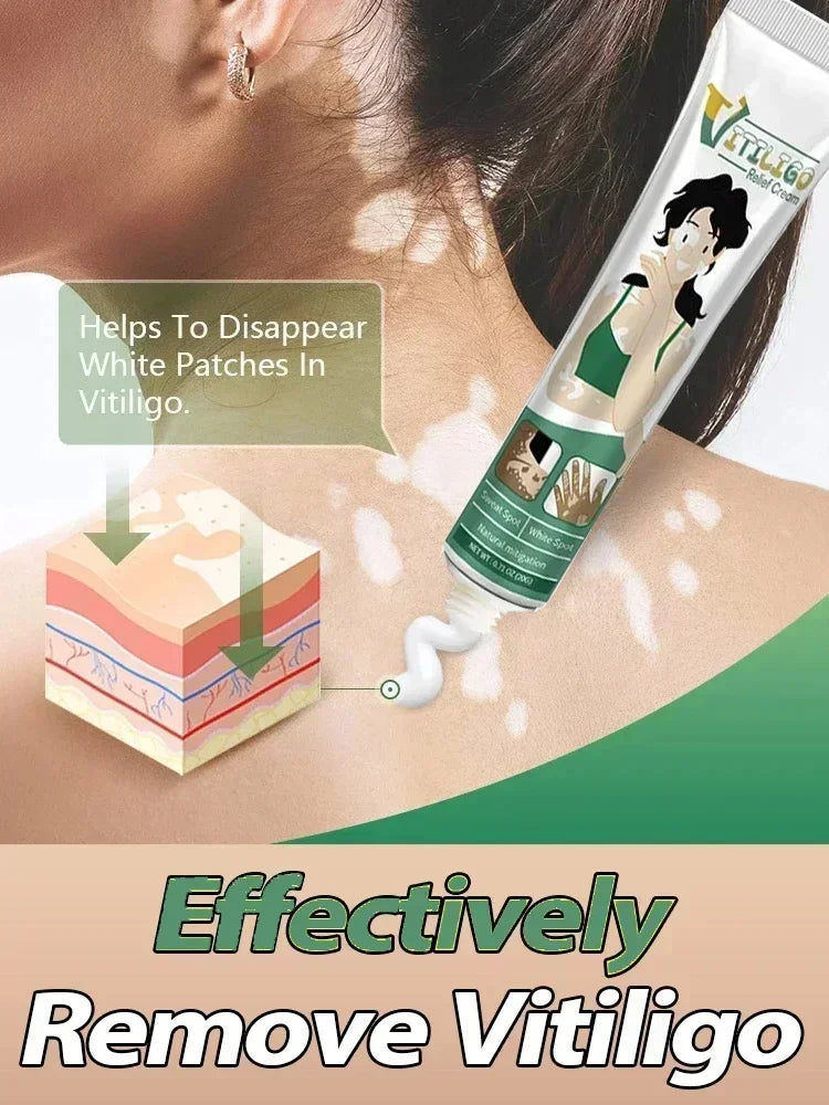 Herbal Extract Vitiligo Ointment Remove Ringworm White Spot Removal Skin care Vitiligo