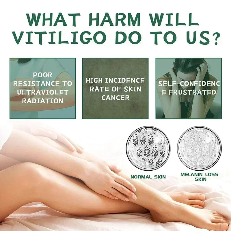 Herbal Extract Vitiligo Ointment Remove Ringworm White Spot Removal Skin care Vitiligo